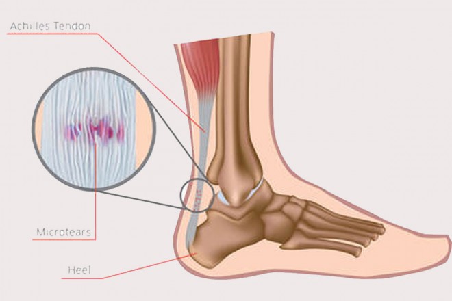 achilles tendinopathy